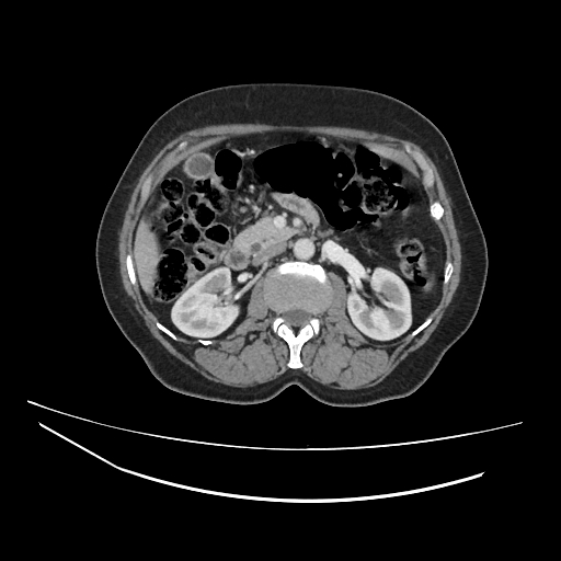 Ampullary tumor (Radiopaedia 60333-67998 A 32).jpg