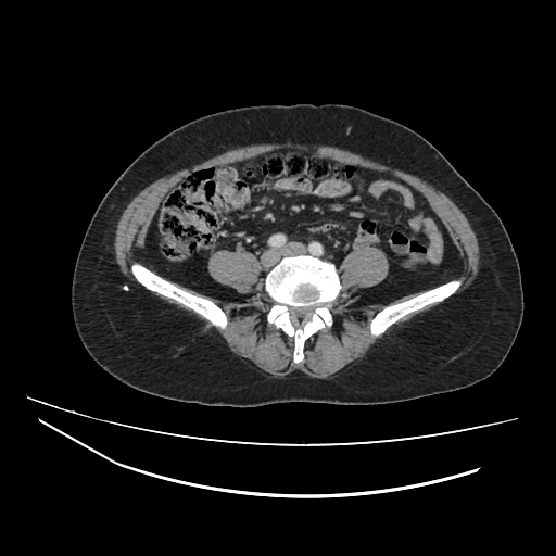 Ampullary tumor (Radiopaedia 60333-67998 A 56).jpg
