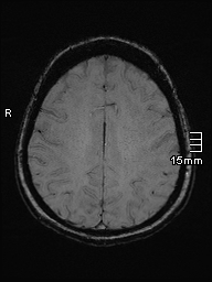 Amyotrophic lateral sclerosis (Radiopaedia 70821-81017 Axial SWI 39).jpg