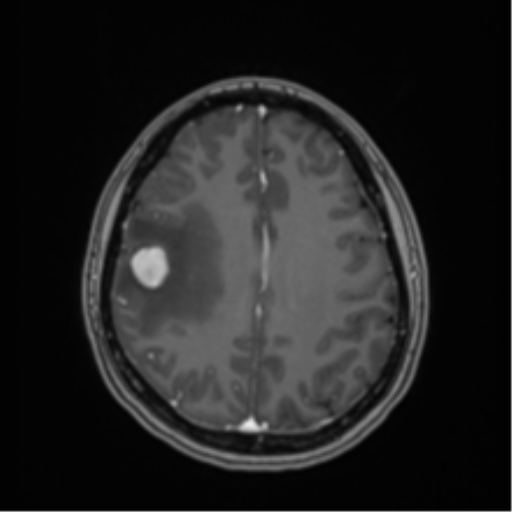 Anaplastic astroblastoma (Radiopaedia 55666-62194 Axial T1 C+ 52).png