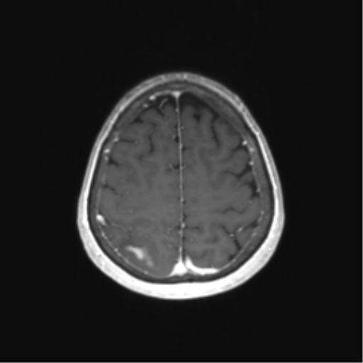 File:Anaplastic astrocytoma (Radiopaedia 86943-103160 Axial T1 C+ 69).png