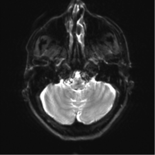 Anaplastic astrocytoma - thalamic glioma (Radiopaedia 59709-67115 Axial DWI 6).png