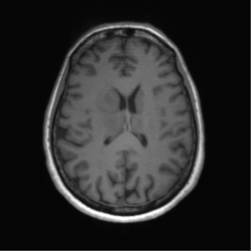 File:Anaplastic astrocytoma - thalamic glioma (Radiopaedia 59709-67115 Axial T1 22).png