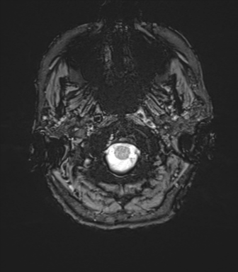 Anaplastic astrocytoma - thalamic glioma (Radiopaedia 59709-67115 G 3).png
