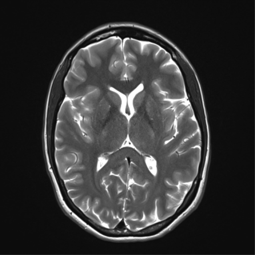 File:Anaplastic astrocytoma IDH mutant (Radiopaedia 50046-55341 Axial T2 21).png
