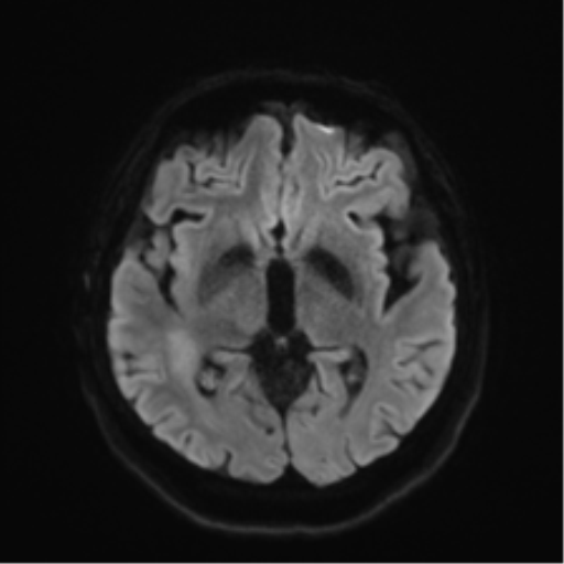 Anaplastic astrocytoma IDH wild-type (pseudoprogression) (Radiopaedia 42209-45279 Axial DWI 40).png