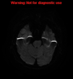 File:Anaplastic ganglioglioma (Radiopaedia 44921-48831 Axial DWI 8).jpg