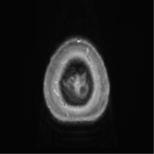 Anaplastic oligodendroglioma (Radiopaedia 83500-98599 Axial T1 C+ 74).png