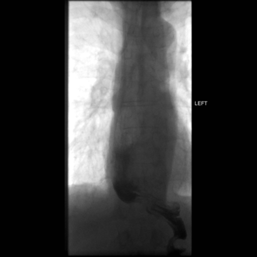 File:Anastomotic stricture post Ivor Lewis esophagectomy (Radiopaedia 47937-52715 C 7).png