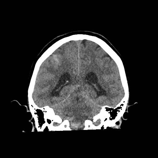 File:Aneursym related subarachnoid hemorrhage with hydrocephalus (Radiopaedia 45105-49083 Coronal non-contrast 42).jpg