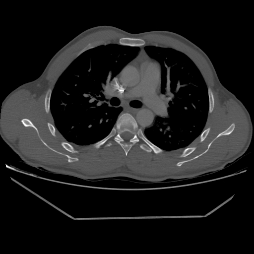 Aneurysmal bone cyst - rib (Radiopaedia 82167-96220 Axial bone window 117).jpg