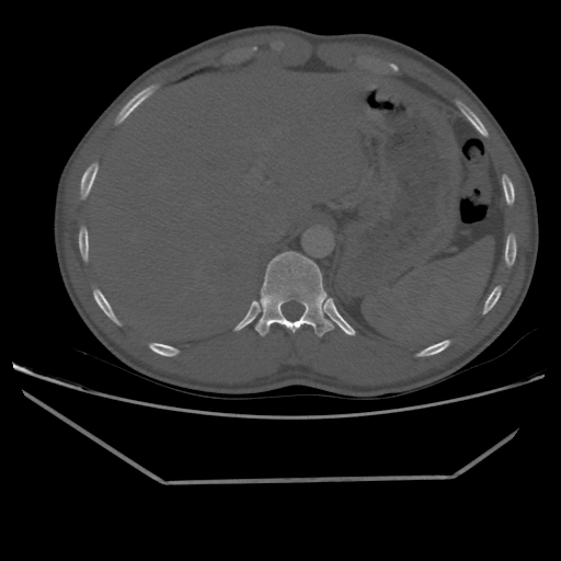 Aneurysmal bone cyst - rib (Radiopaedia 82167-96220 Axial bone window 230).jpg