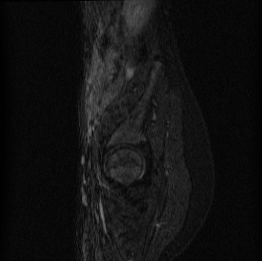 File:Aneurysmal bone cyst - sacrum (Radiopaedia 65190-74196 Sagittal STIR 6).jpg