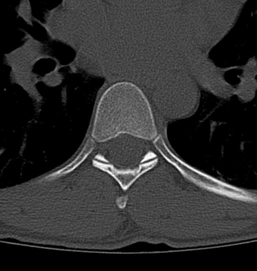Aneurysmal bone cyst T11 (Radiopaedia 29294-29721 Axial bone window 8).jpg