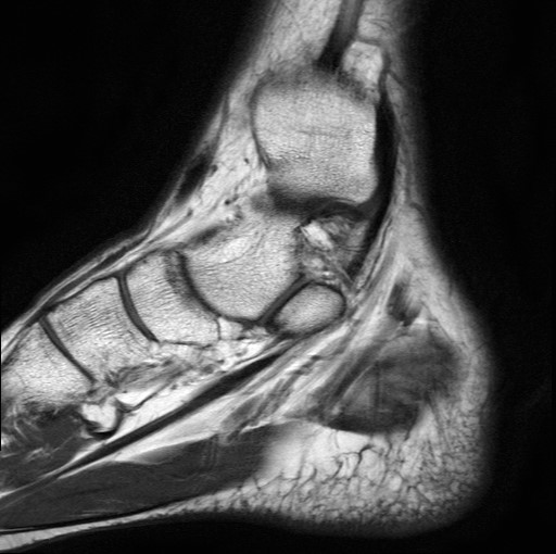 File:Aneurysmal bone cyst of the calcaneus (Radiopaedia 60669-68420 Sagittal T1 17).jpg