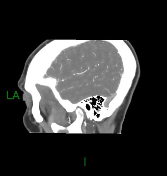 Aneurysmal subarachnoid hemorrhage with intra-axial extension (Radiopaedia 84371-99732 B 11).jpg