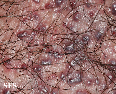 Angiokeratoma Of The Scrotum (Dermatology Atlas 11).jpg