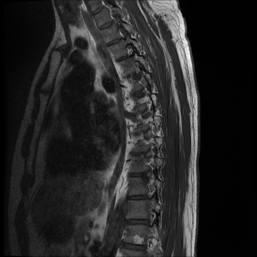 File:Angiolipoma - thoracic spine (Radiopaedia 28242-28479 Sagittal T1 4).jpg