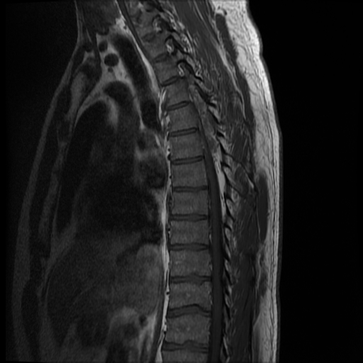 File:Angiolipoma - thoracic spine (Radiopaedia 28242-28479 Sagittal T1 9).jpg