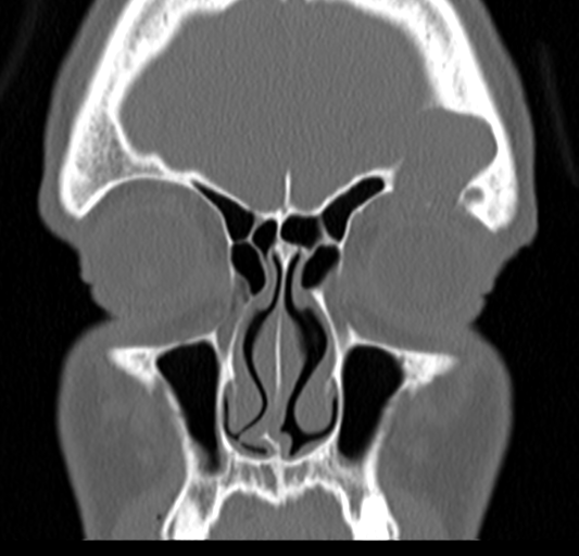 Angular epidermoid cyst (Radiopaedia 46908-51439 Coronal bone window 21).png
