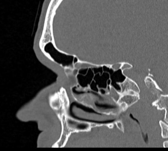 Angular epidermoid cyst (Radiopaedia 46908-51439 Sagittal bone window 56).png