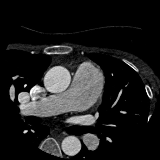 File:Anomalous left coronary artery from the pulmonary artery (ALCAPA) (Radiopaedia 40884-43586 A 1).jpg