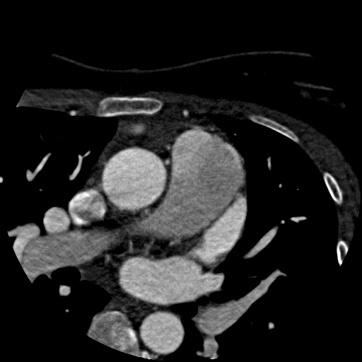 File:Anomalous left coronary artery from the pulmonary artery (ALCAPA) (Radiopaedia 40884-43586 A 7).jpg