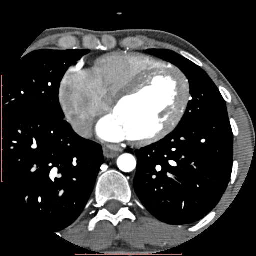 File:Anomalous left coronary artery from the pulmonary artery (ALCAPA) (Radiopaedia 70148-80181 A 231).jpg
