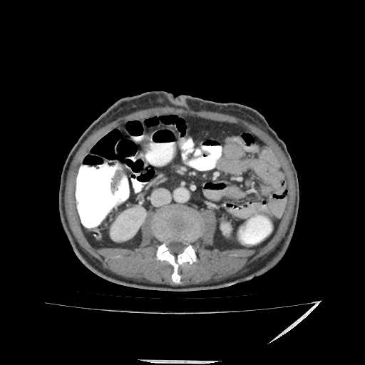Anorectal carcinoma (Radiopaedia 44413-48064 A 27).jpg