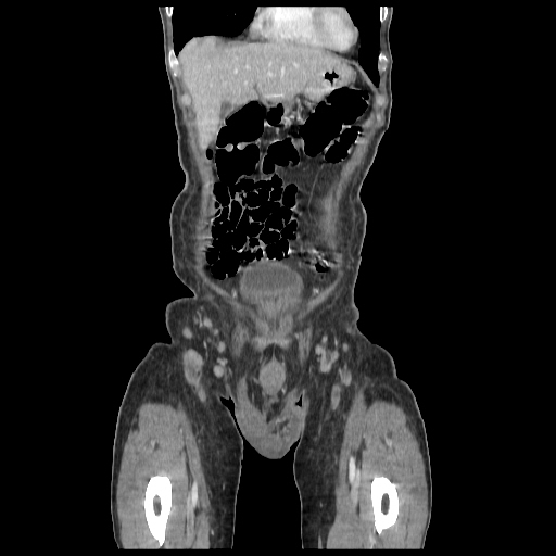Anorectal carcinoma (Radiopaedia 44413-48064 B 3).jpg