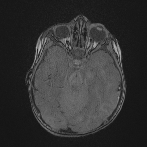Anoxic brain injury (Radiopaedia 79165-92139 Axial MRA 78).jpg