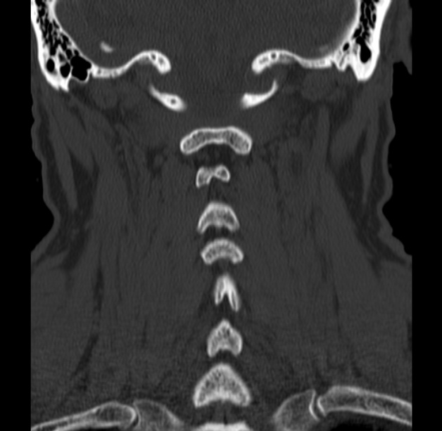 Anterior cervical postdiscectomy arthrodesis (Radiopaedia 32678-33646 Coronal bone window 49).jpg