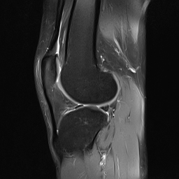 File:Anterior cruciate ligament full thickness tear (Radiopaedia 66268-75467 Sagittal PD fat sat 16).jpg