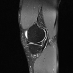 File:Anterior cruciate ligament full thickness tear (Radiopaedia 66268-75467 Sagittal PD fat sat 6).jpg