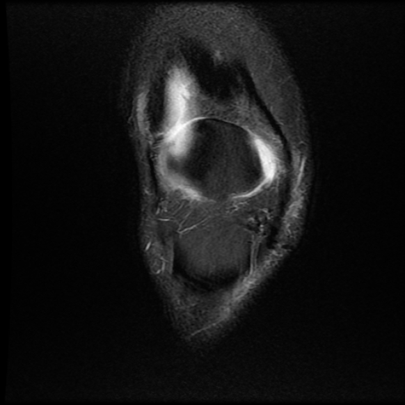 File:Anterior cruciate ligament graft tear and bucket-handle tear of medial meniscus (Radiopaedia 75867-87255 Coronal PD fat sat 5).jpg
