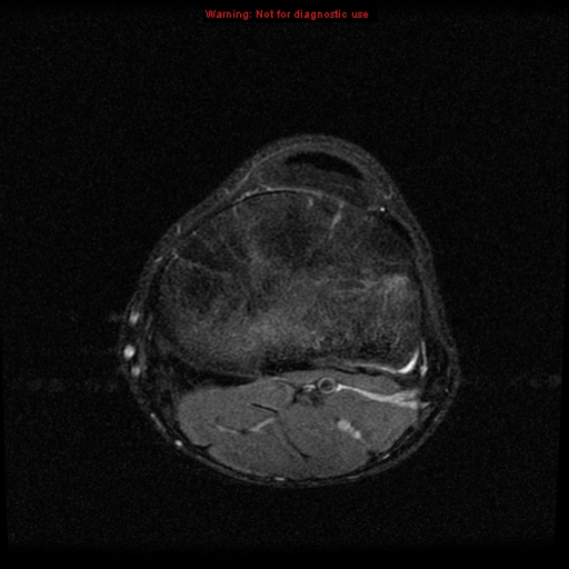 File:Anterior cruciate ligament injury - partial thickness tear (Radiopaedia 12176-12515 Axial PD 19).jpg
