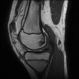 File:Anterior cruciate ligament tear - pediatric (Radiopaedia 62152-70260 Sagittal PD 65).jpg
