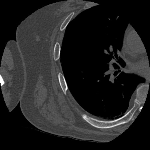 Anterior glenohumeral dislocation with Hill-Sachs lesion (Radiopaedia 62877-71249 Axial bone window 104).jpg