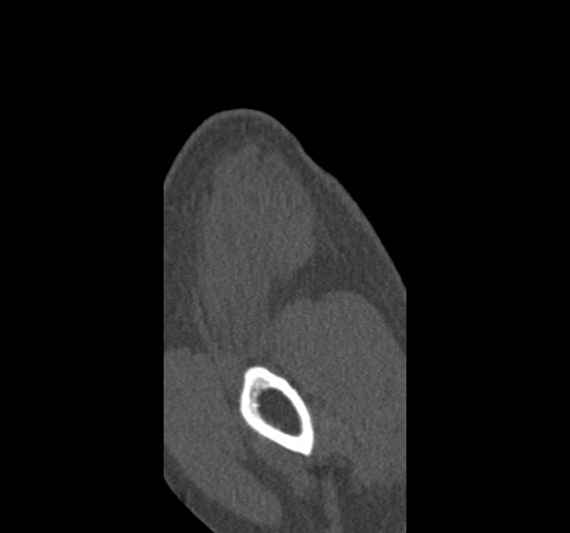 Anterior glenohumeral dislocation with Hill-Sachs lesion (Radiopaedia 62877-71249 Sagittal bone window 5).jpg