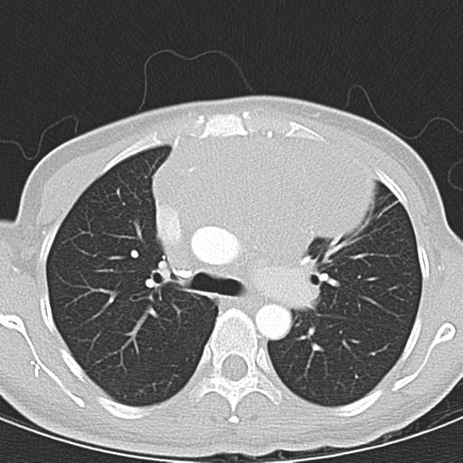 Anterior mediastinal lymphoma (Radiopaedia 29556-30061 Axial lung window 20).jpg
