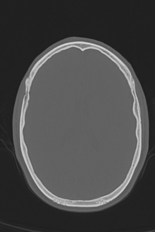 Anterior nasal spine fracture (Radiopaedia 46138-50494 Axial bone window 25).png