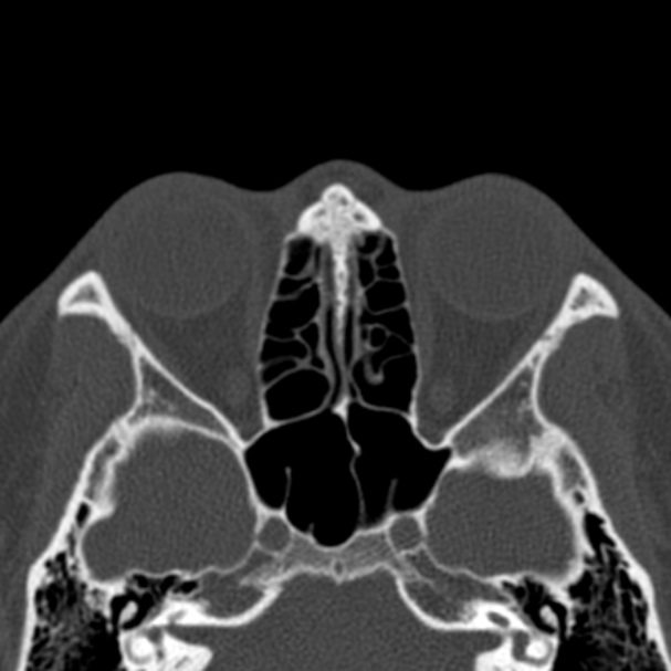 Antrochoanal polyp (Radiopaedia 33984-35202 Axial bone window 50).jpg