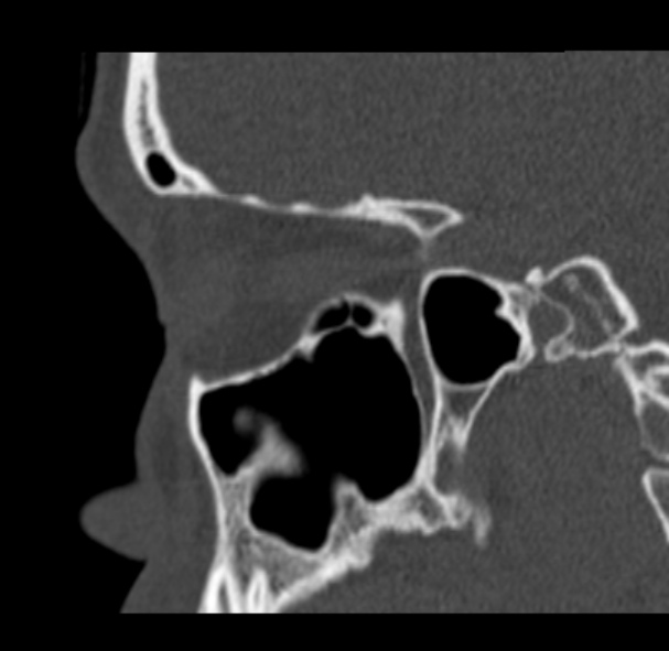 Antrochoanal polyp (Radiopaedia 33984-35202 Sagittal bone window 56).jpg