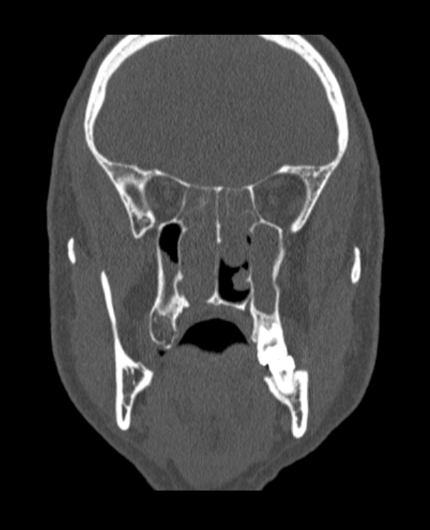 Antrochoanal polyp (Radiopaedia 79011-92169 Coronal bone window 37).jpg