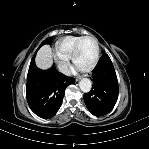 File:Aortic aneurysm and Lemmel syndrome (Radiopaedia 86499-102554 A 7).jpg