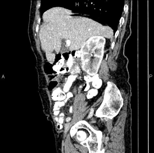 Aortic aneurysm and Lemmel syndrome (Radiopaedia 86499-102554 D 25).jpg