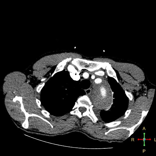 File:Aortic aneurysm and penetrating ulcer (Radiopaedia 23590-23704 A 6).jpg