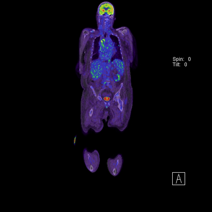 Aortic arch graft infection (FDG PET-CT) (Radiopaedia 71975-82438 B 44).jpg