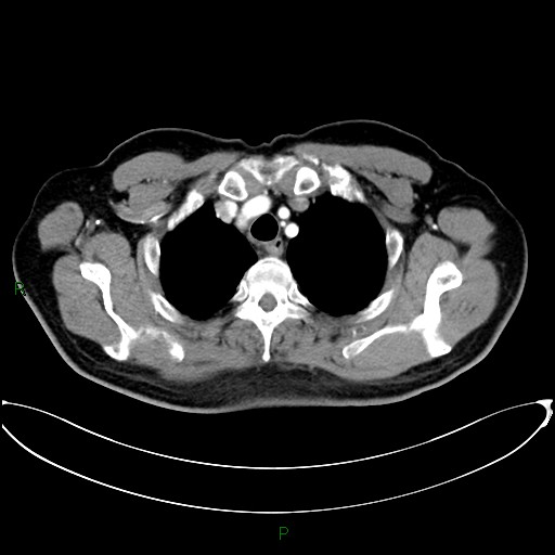 Aortic arch origin of left vertebral artery (Radiopaedia 46327-50737 Axial post contrast 21).jpg