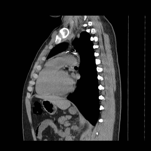 File:Aortic arch stent (Radiopaedia 30030-30595 B 18).jpg